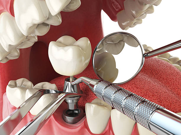Best Emergency Dentist for Knocked-Out Tooth in Ralls, TX